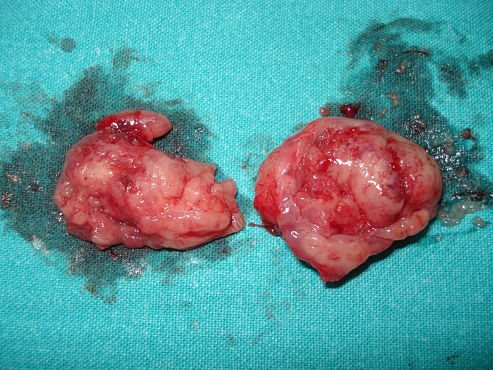 File:Tonsillectomy tonsils.JPEG