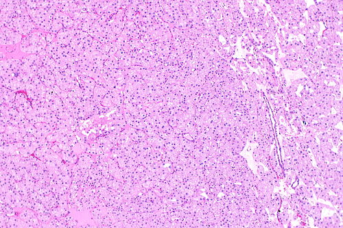 Eosinophilic variant of chromophobe renal cell carcinoma -- low mag.jpg