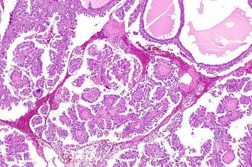 Hereditary leiomyomatosis and renal cell carcinoma associated RCC -- low mag.jpg