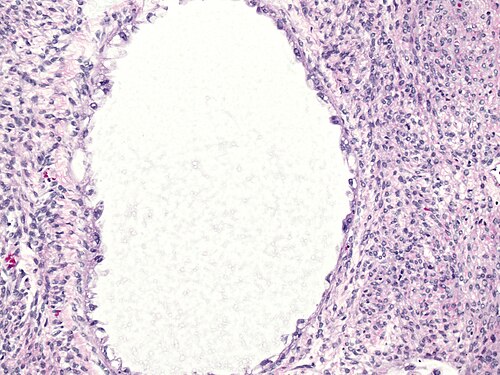 High magnification of tubulocystic clear cell carcinoma of ovary.jpg