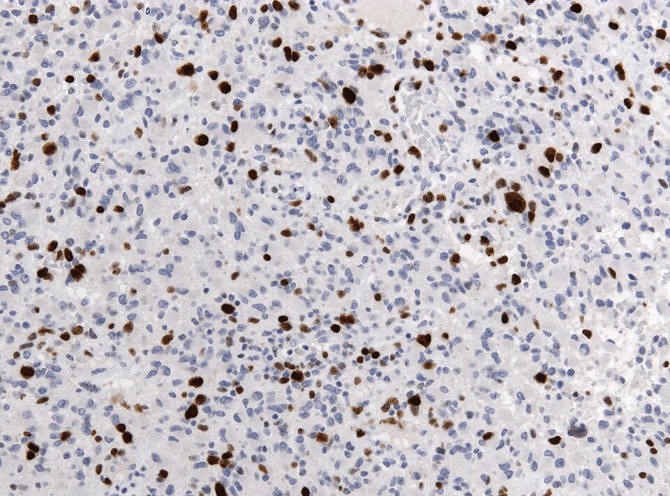 File:Neuropathology case IX 06.jpg