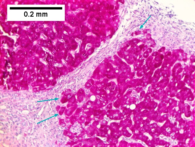 Hepatitis C - Libre Pathology