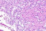 Eosinophilic, solid and cystic renal cell carcinoma - 3 -- intermed mag.jpg