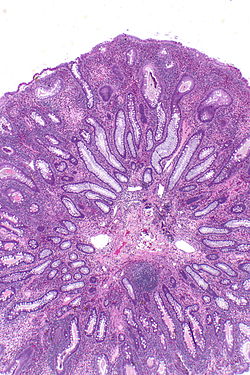 Inflammatory polyp -- very low mag.jpg