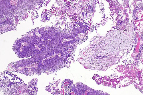 Plasmacytoid urothelial carcinoma -- very low mag.jpg