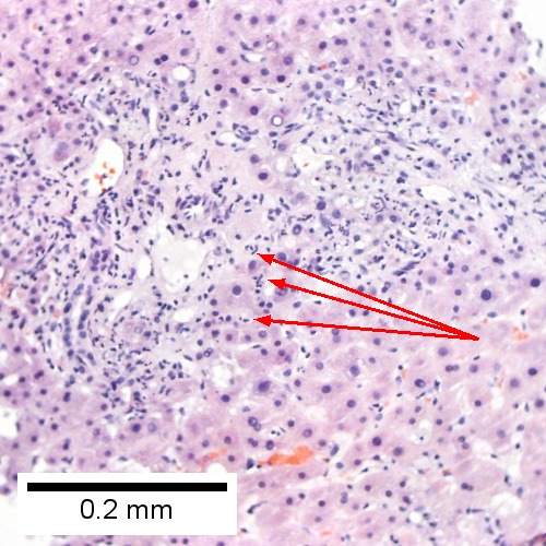 Neutrophils about hepatocytes (arrows) have spilled into the lobule from a portal tract (Row 1 Right 200X).