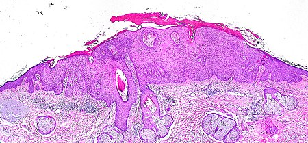 Actinic Keratosis - Libre Pathology