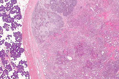 Carcinoma ex pleomorphic adenoma -- very low mag.jpg