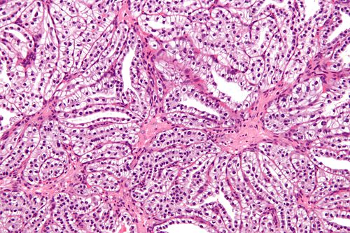 Clear cell papillary renal cell carcinoma - high mag.jpg