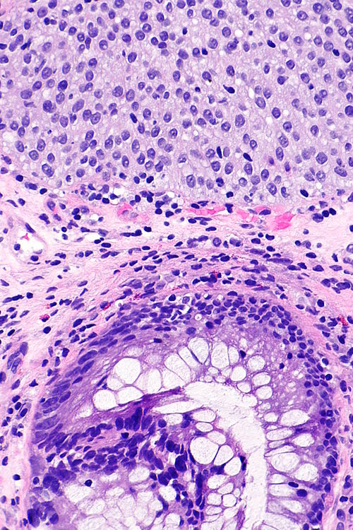 Cystitis cystica et glandularis -- high mag.jpg