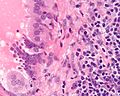 Endosalpingiosis in lymph node - cropped - very high mag.jpg