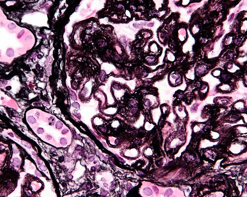 Membranous nephropathy - cropped - mpas - very high mag.jpg