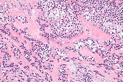 Hyalinizing clear cell carcinoma - high mag.jpg