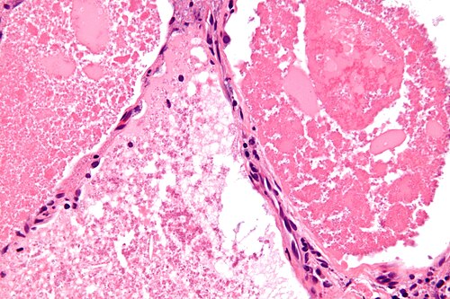 Pulmonary alveolar proteinosis -3- very high mag.jpg