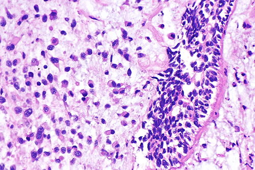 Plasmacytoid urothelial carcinoma -- high mag.jpg