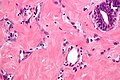 Pseudoangiomatous stromal hyperplasia - very high mag.jpg