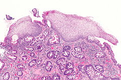 Barrett's esophagus - Libre Pathology