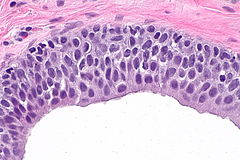 Walthard cell rest - Libre Pathology