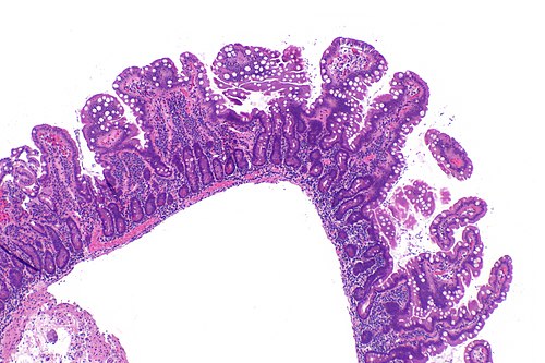 Giardia small bowel -- low mag.jpg