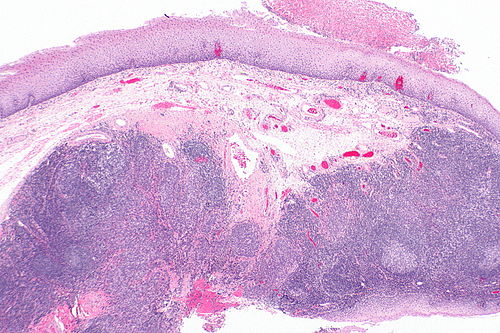 Squamous cell carcinoma - p16 positive -- very low mag.jpg