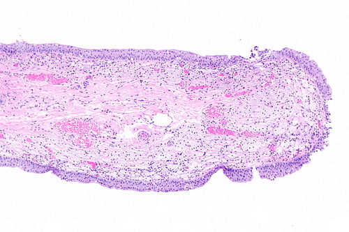 Urinary bladder xanthoma -- low mag.jpg