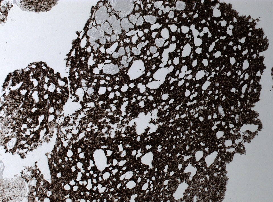 File:Neuropathology case II 05.jpg