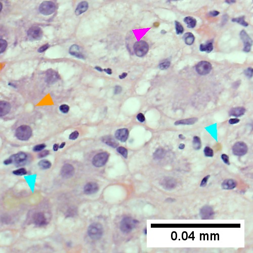 Bile in hepatocytes [cyan arrrowhead] & in canaliculi [purple arrowheads]. Empty acinar spaces bounded by hepatocytes [orange arrowhead] (400X, higher pixel),
