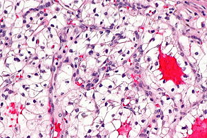 RENAL CELL CARCINOMA- CLEAR CELL TYPE - Pathology Made Simple