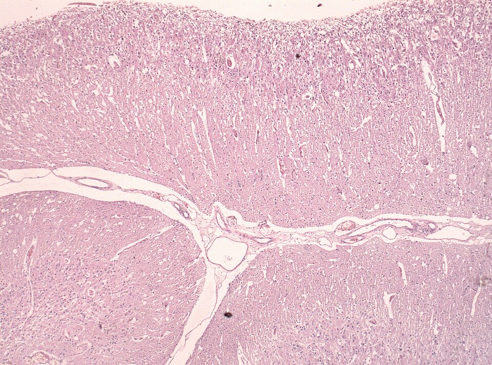 File:Dysplastic gangliocytoma lhermitte duclos.jpg