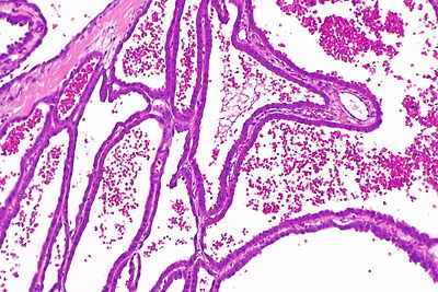 Tubulocystic carcinoma of the kidney -- intermed mag.jpg