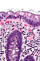 Intestinal spirochetosis - cropped - very high mag.jpg