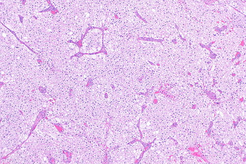 Chromophobe renal cell carcinoma -- low mag.jpg