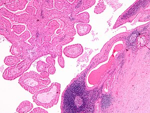 warthin's tumor histology volume prostata valori normali ml