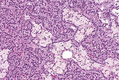 Papillary renal cell carcinoma - 2 -- intermed mag.jpg