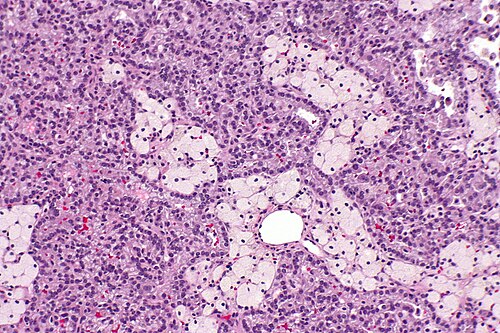 Papillary renal cell carcinoma - 2 -- intermed mag.jpg