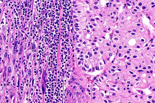 Chromophobe renal cell carcinoma with sarcomatoid differentiation -- high mag.jpg