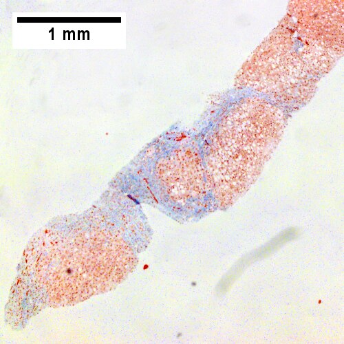 Trichrome shows blue fibrosis about hepatocyte nodules