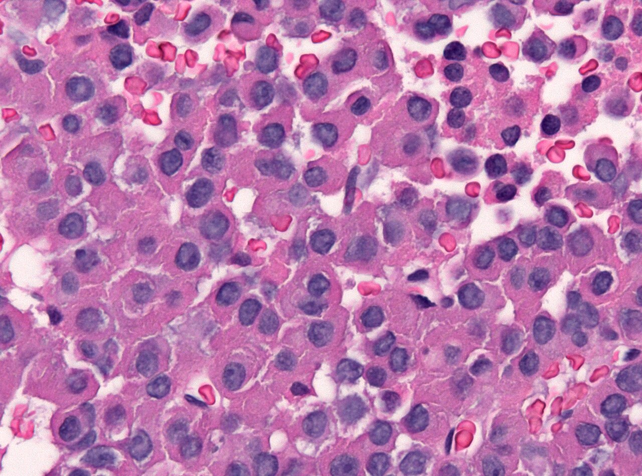 Аденома спорт