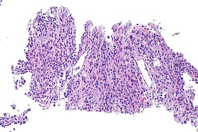 Pneumocytoma - alt -- intermed mag.jpg