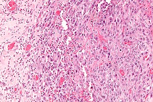 cancer sarcoma epitelioide după îndepărtarea verucilor genitale  înflorire albă
