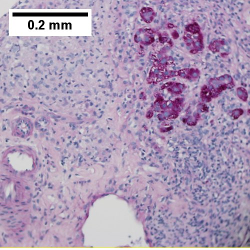 Piecemeal necrosis, PAS without diastase