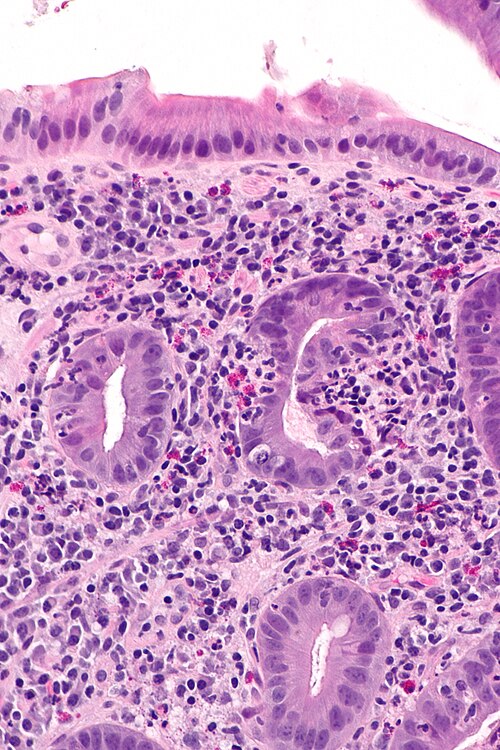 File:Acute duodenitis -- high mag.jpg