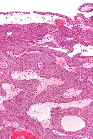urothelialis papilloma ck20 az emberi galandféreg következményei