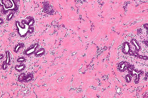 Pseudoangiomatous stromal hyperplasia -a- intermed mag.jpg
