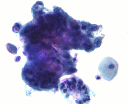 Adenocarcinoma on pap test 1 and 2.gif