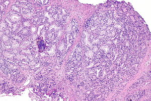 Papillary urothelial hyperplasia pathology - Cauzele condilomului cervical