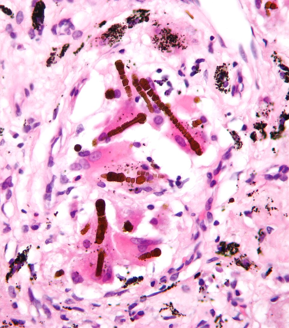File:Ferruginous body.jpg