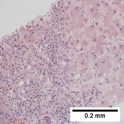 Bile ductular proliferation with interface hepatitis [inflammation of periportal hepatocytes] (200X).