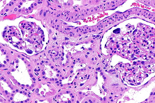 Cystinosis - kidney -- high mag.jpg