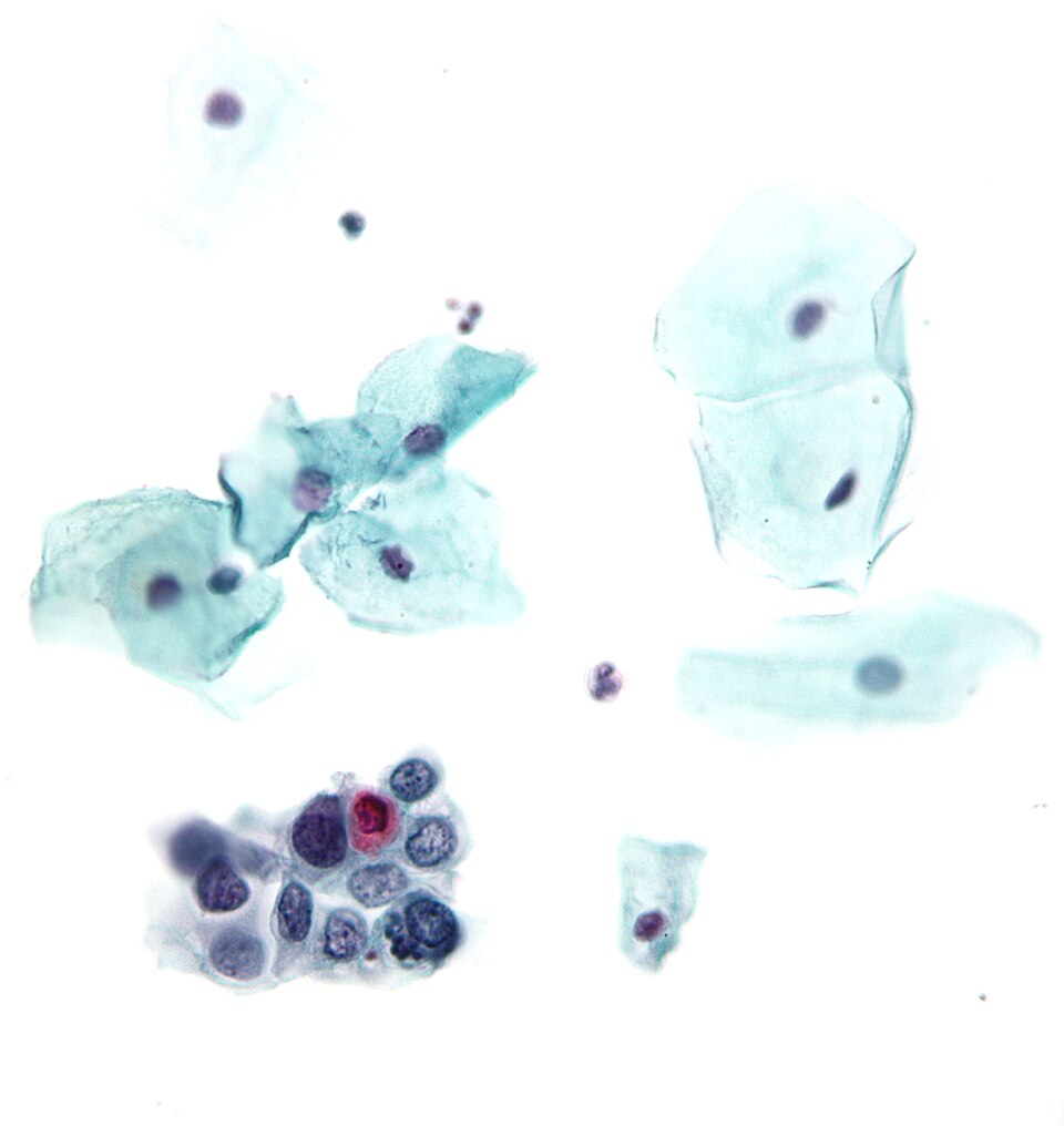 File:High-grade squamous intraepithelial lesion.jpg